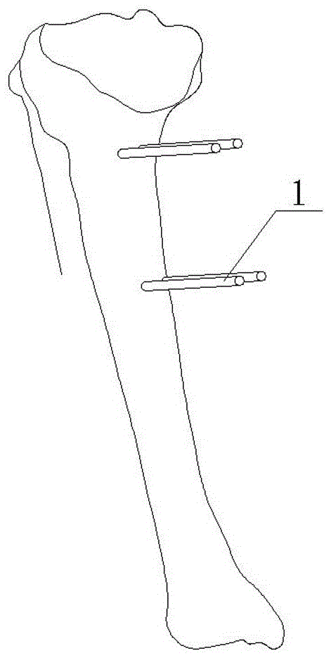 combined osteotomy guide