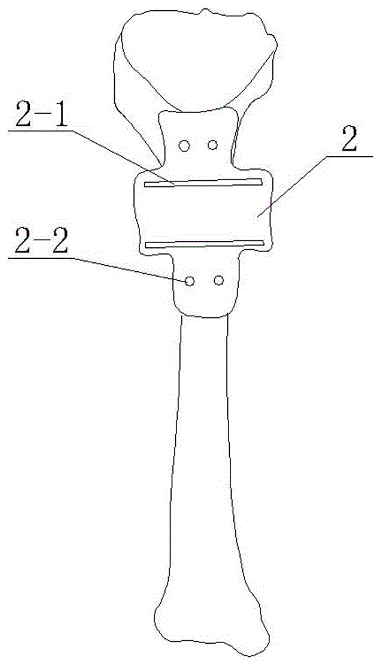 combined osteotomy guide