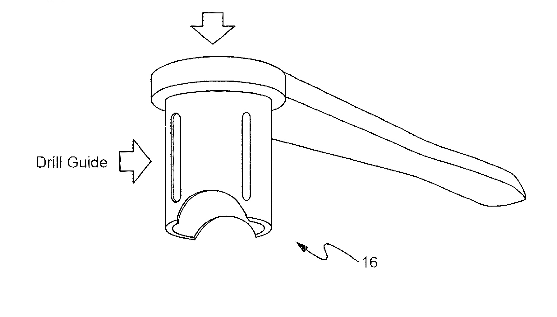 Method for preparing recipient site and implanting allogenic bone graft