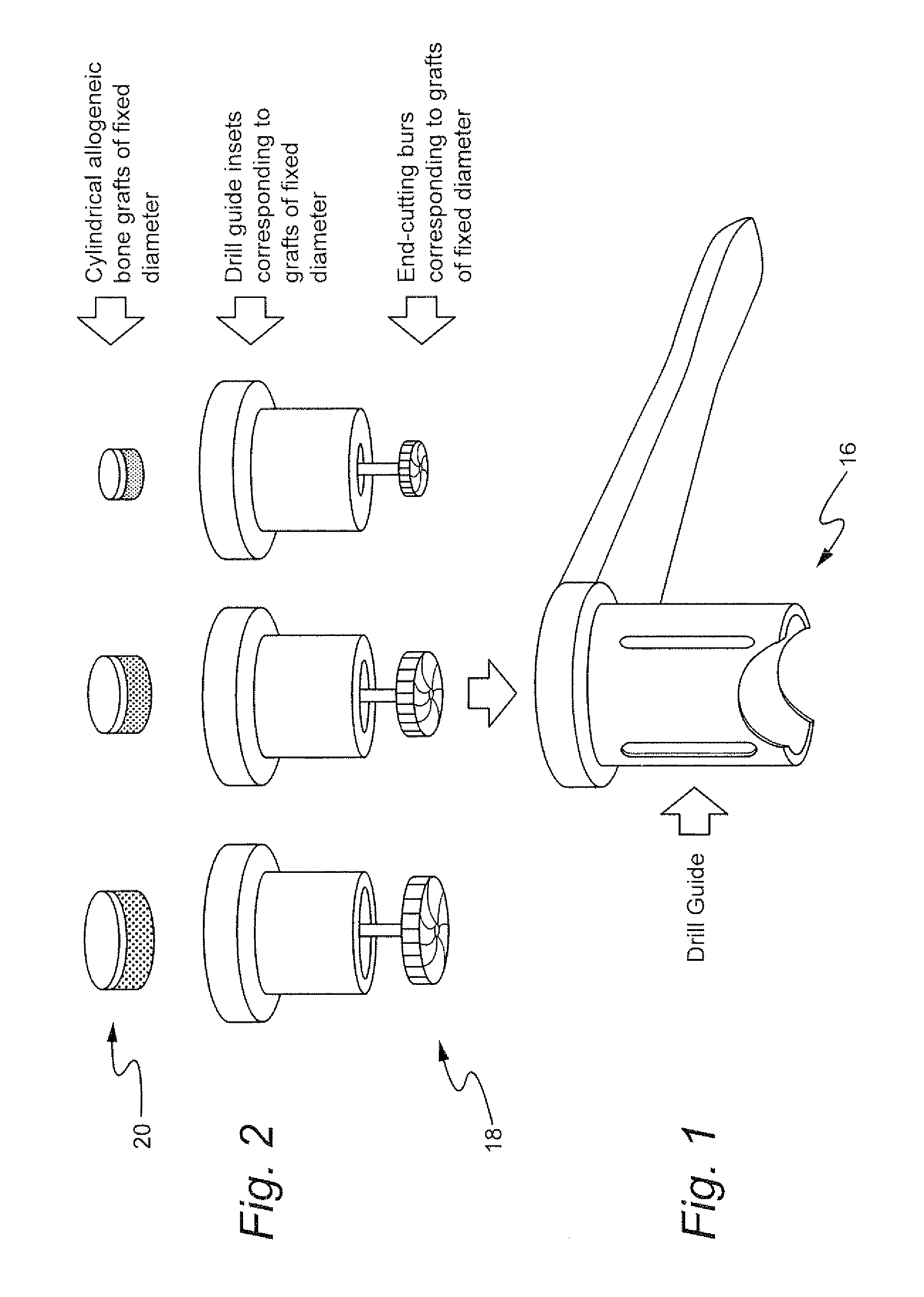 Method for preparing recipient site and implanting allogenic bone graft