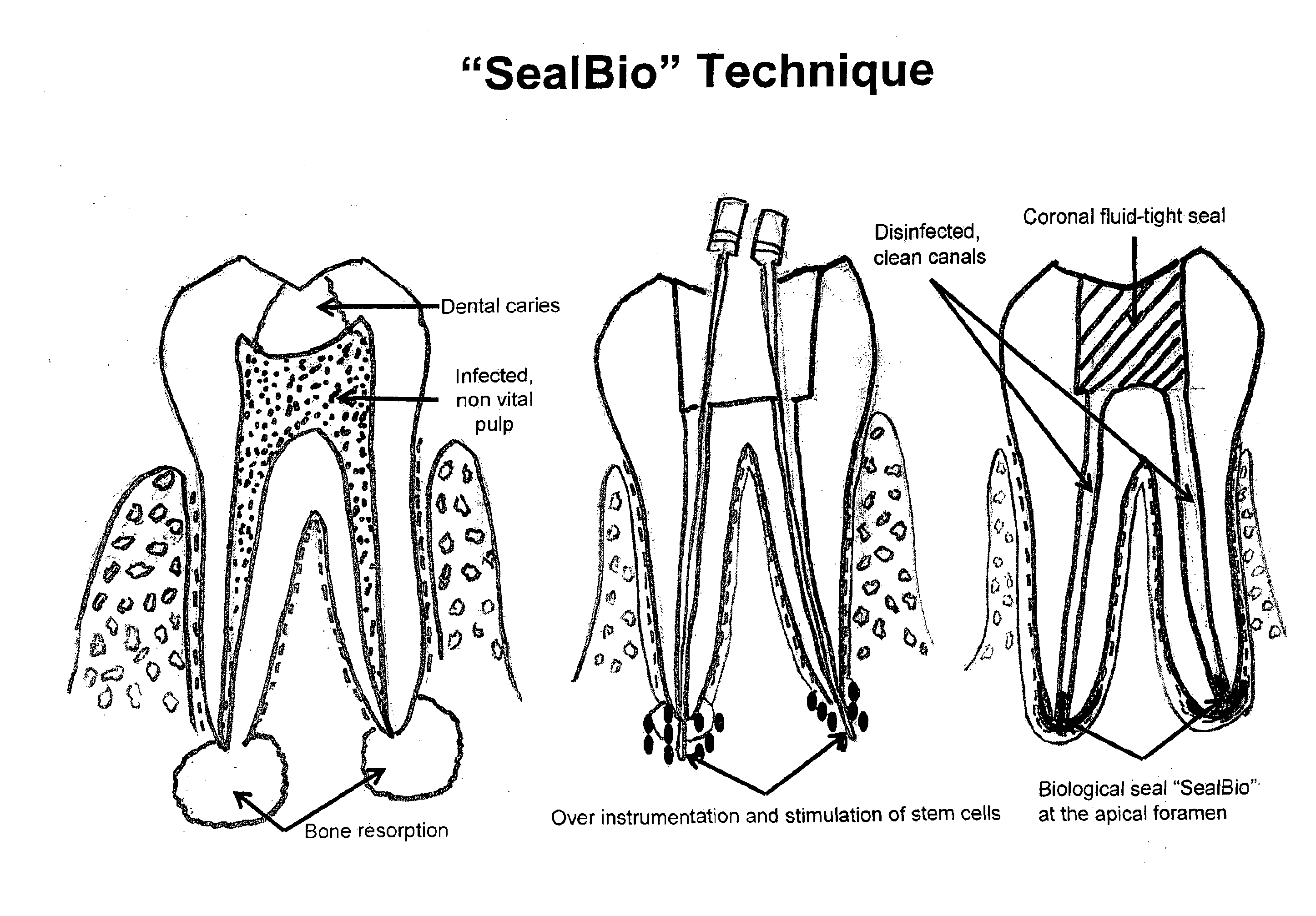 Sealbio:  a novel non-obturation regenerative technique of endodontic treatment