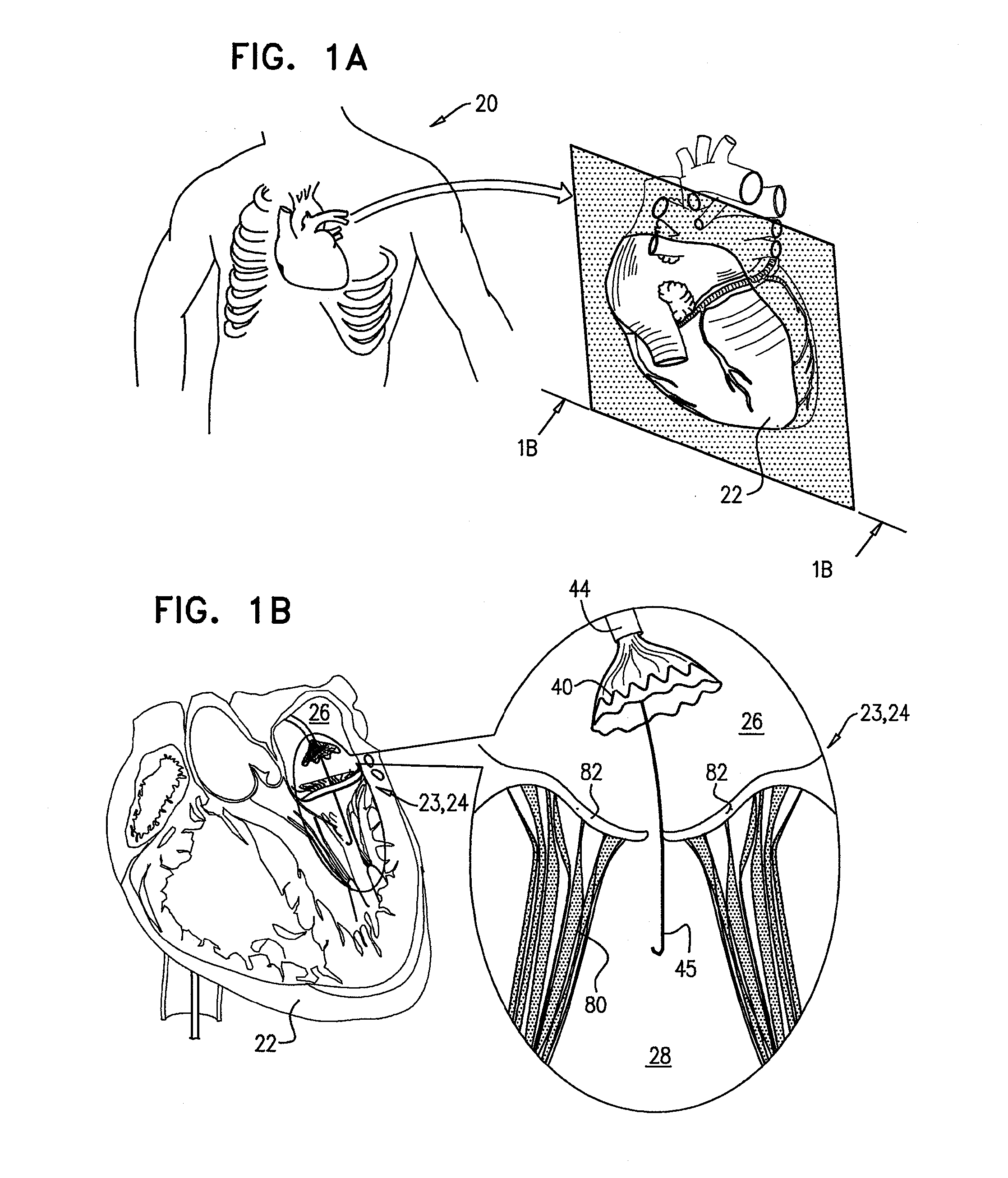 Techniques for percutaneous mitral valve replacement and sealing