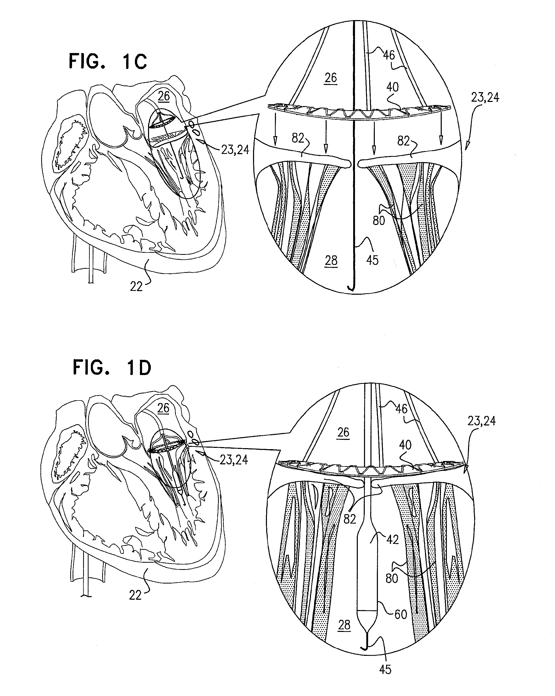 Techniques for percutaneous mitral valve replacement and sealing