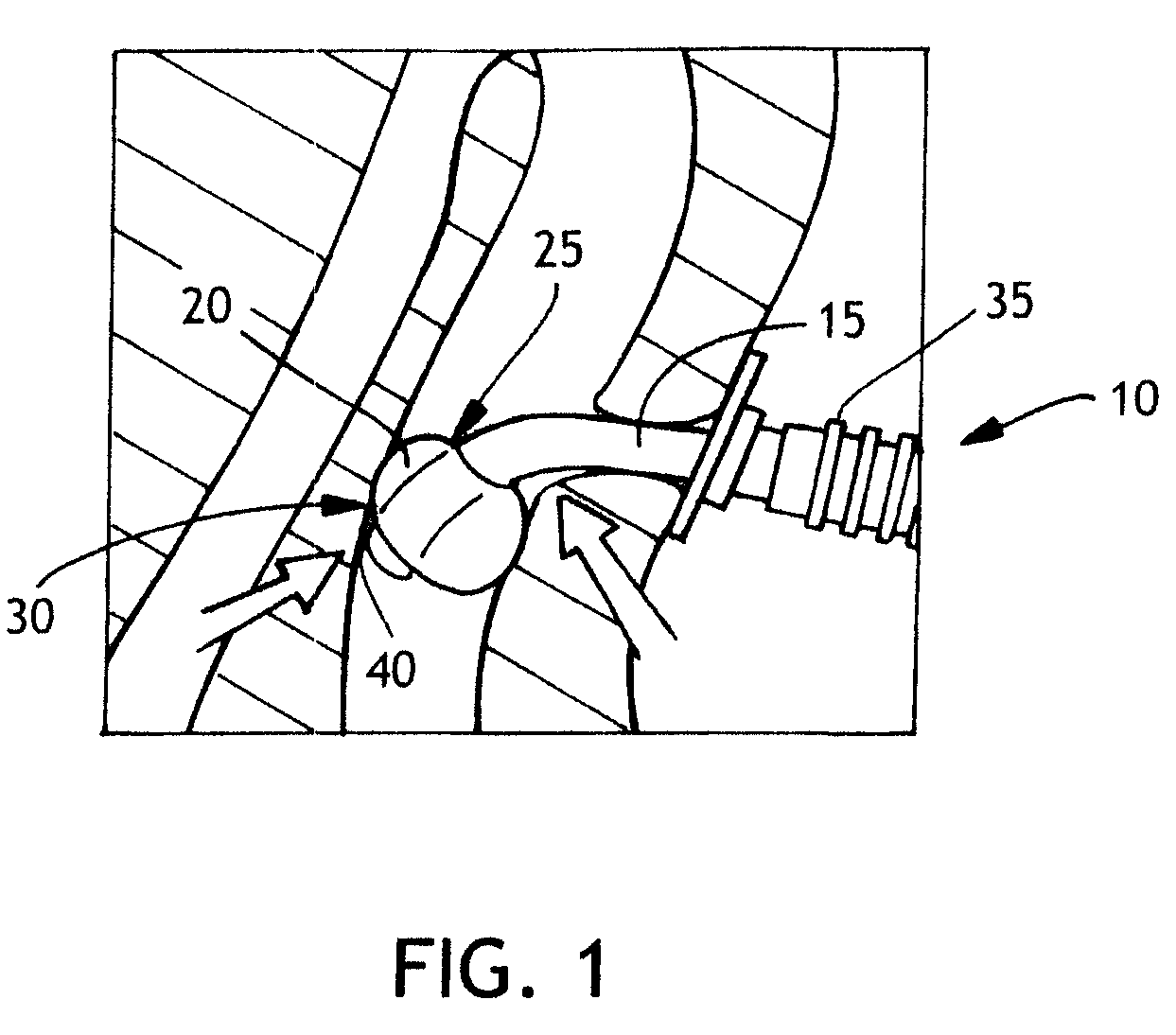 Balloon cuff tracheostomy tube