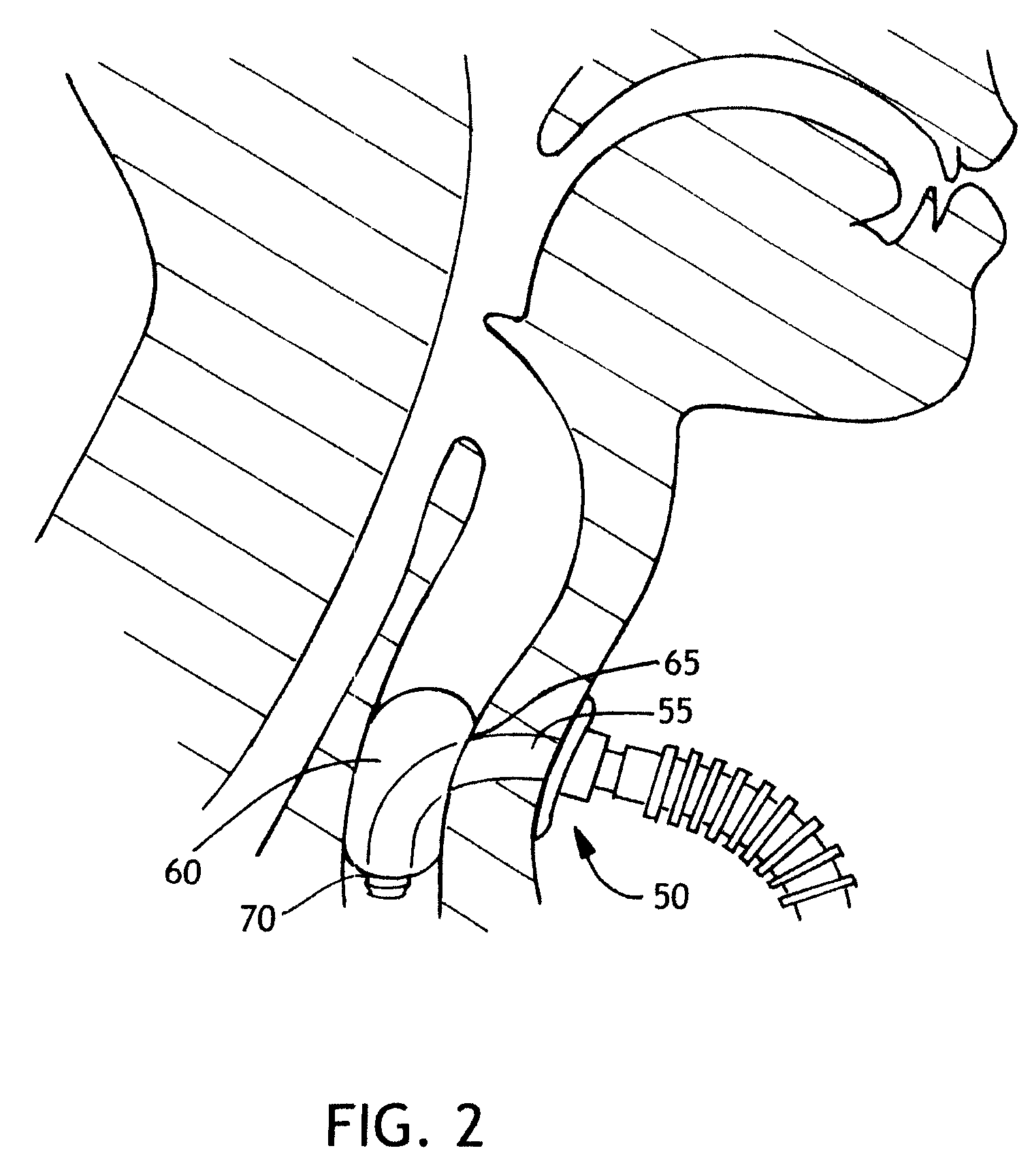 Balloon cuff tracheostomy tube