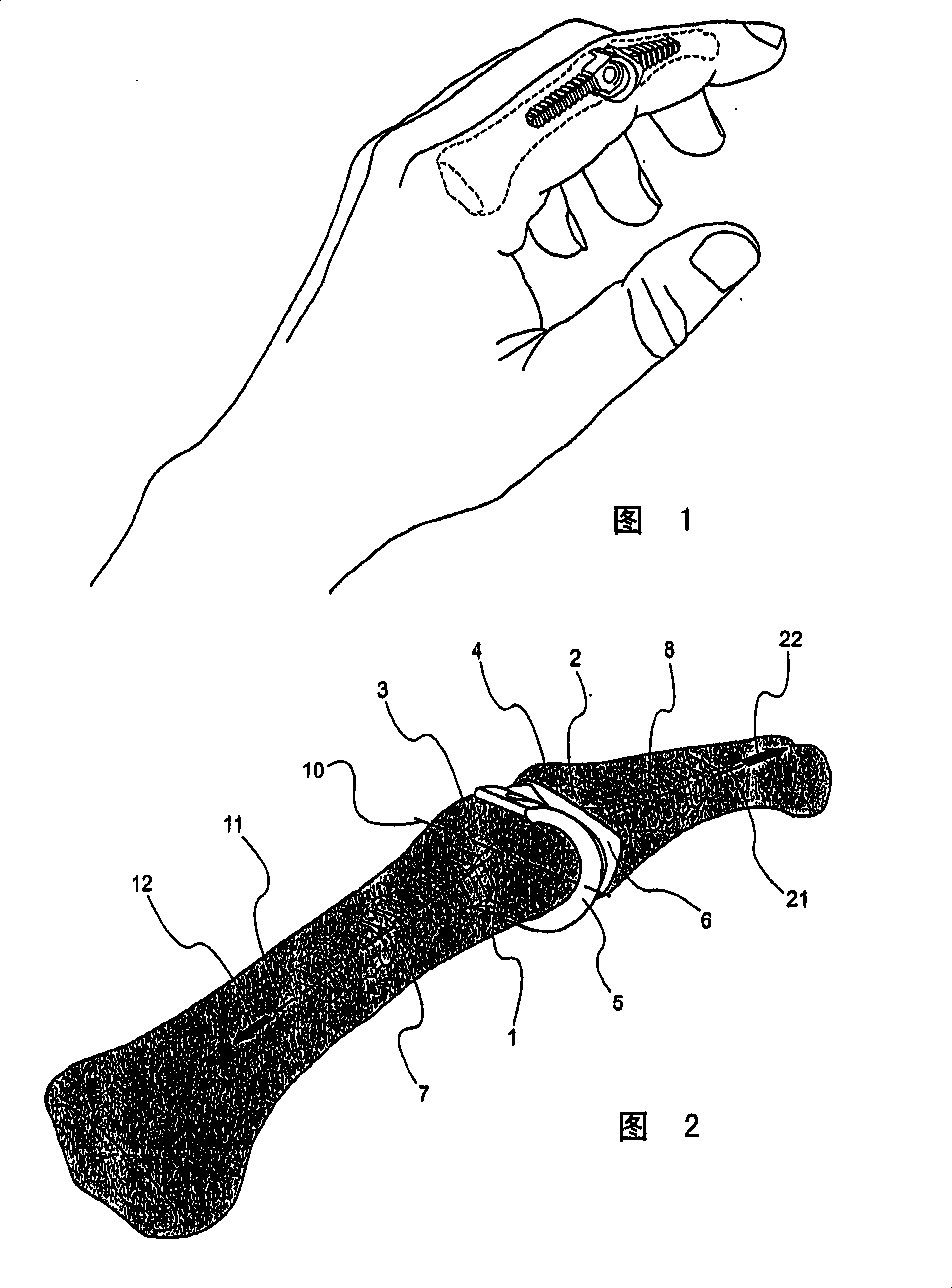 Prosthetic device for total joint replacement in small joint arthroplasty