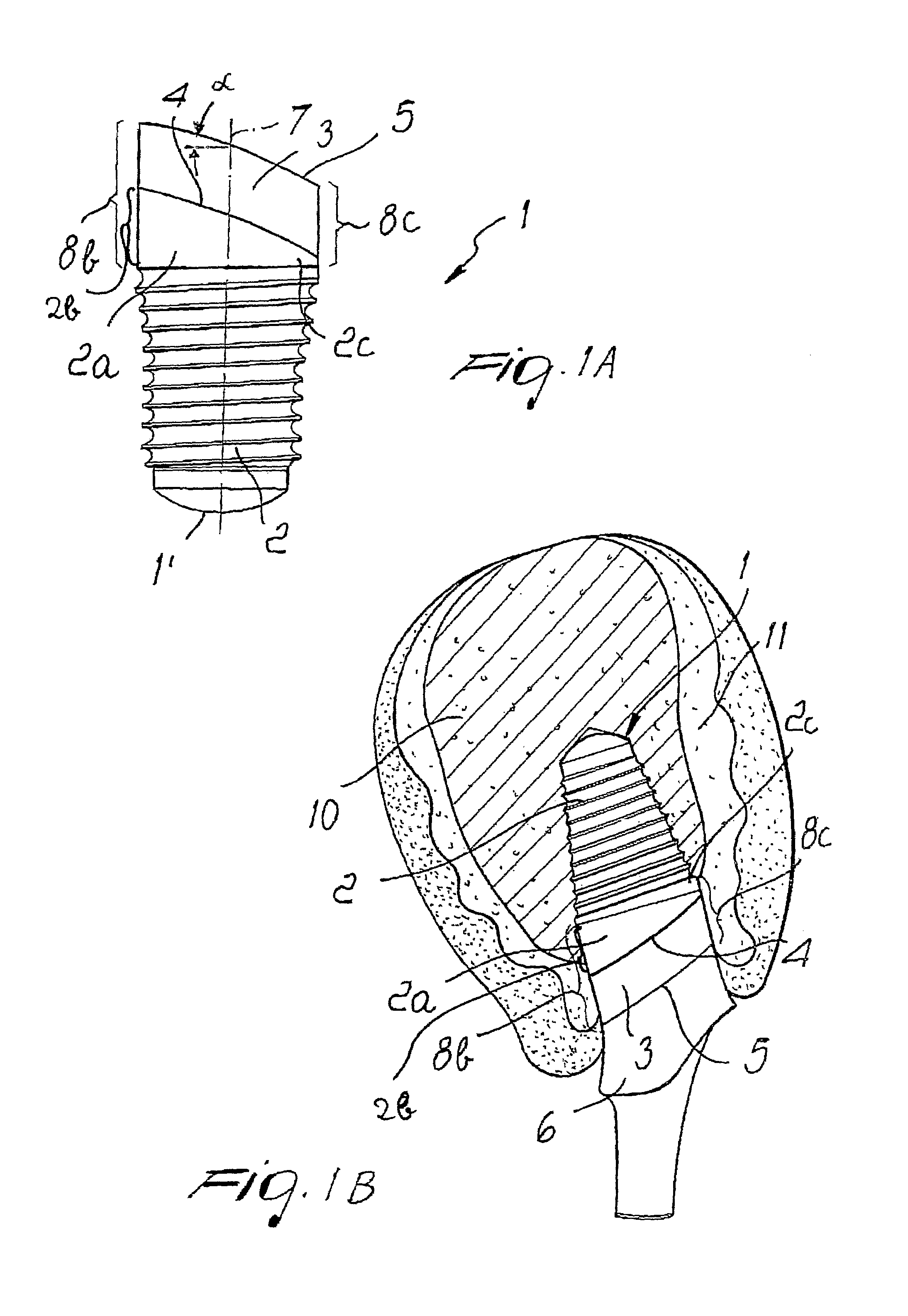 Dental implant with positioning means