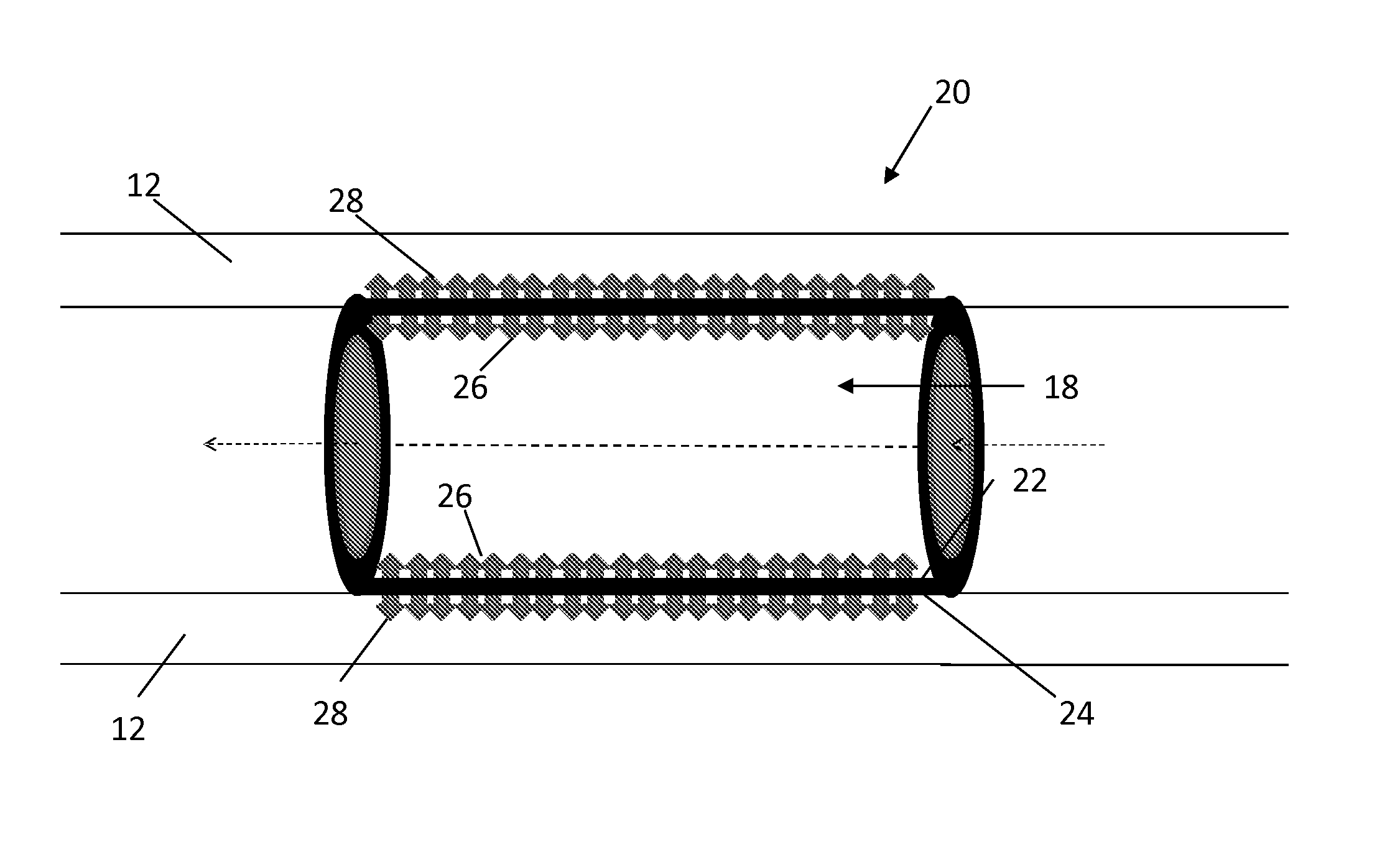 Methods, Systems, and Devices Relating to Directional Eluting Implantable Medical Devices