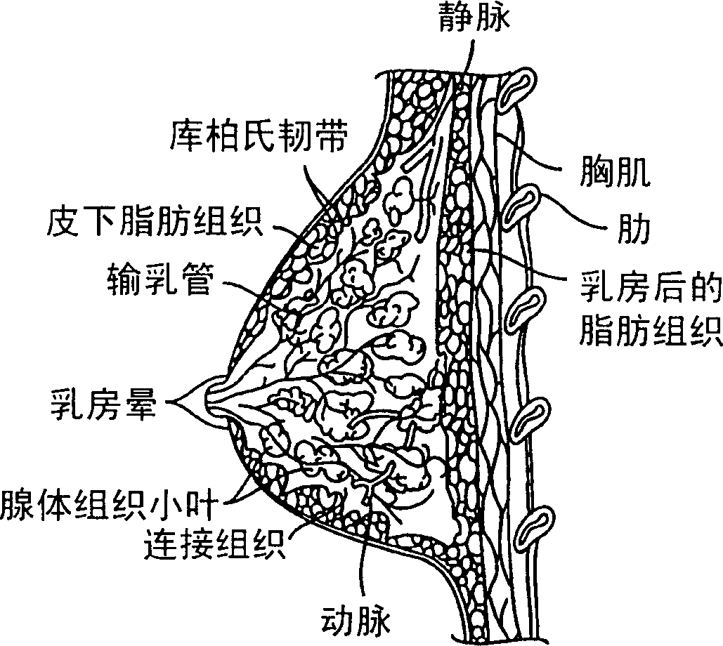 Method and apparatus for treating breast lesions using microwaves