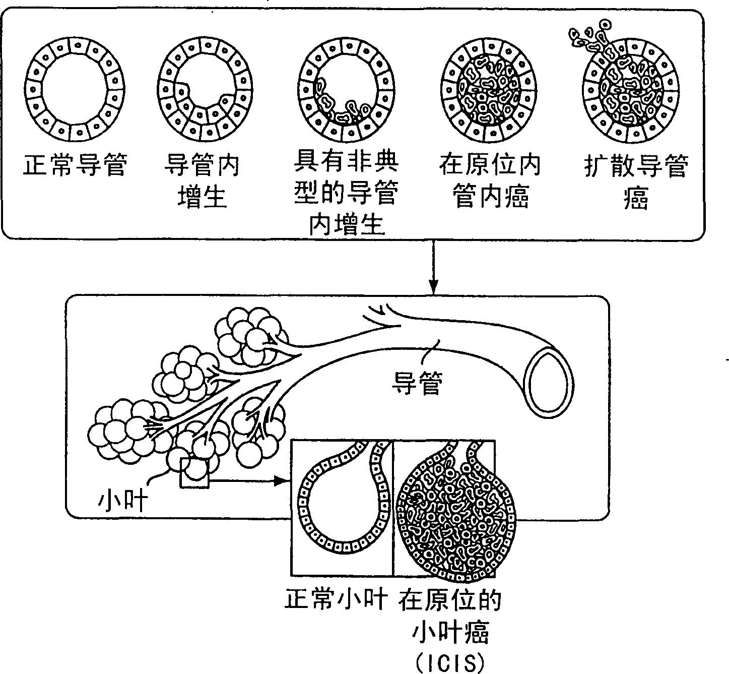 Method and apparatus for treating breast lesions using microwaves