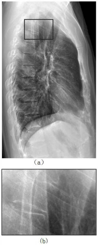 Lateral chest radiography bone suppression method based on deep convolutional neural network