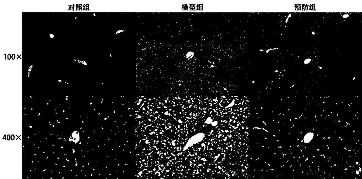 Chinese medicinal compound preparation for preventing non-alcoholic fatty liver disease