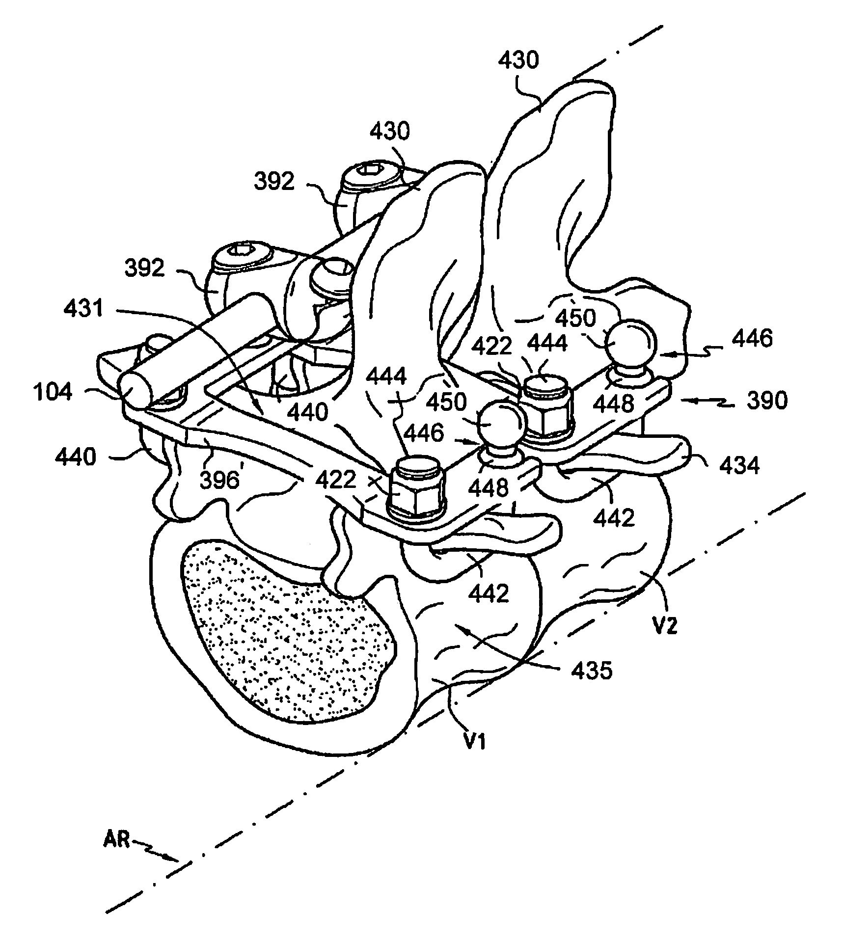 Dynamic spine stabilization system