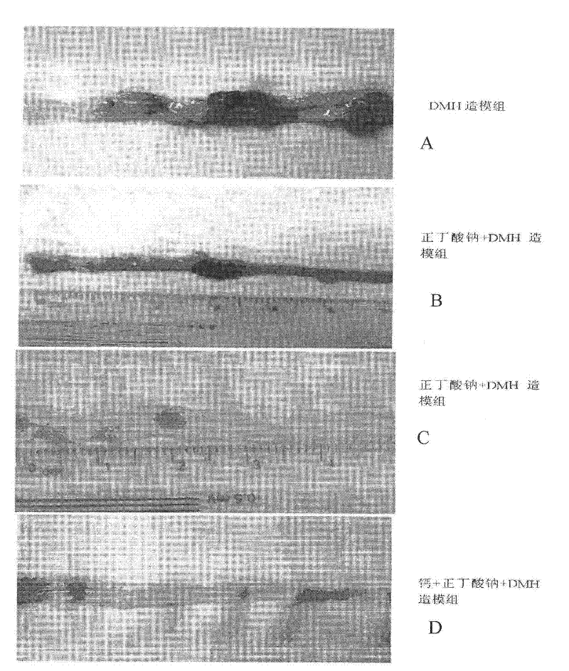 Pharmaceutical composition containing medicinal calcium salt for early preventing colorectal adenoma or colorectal cancer