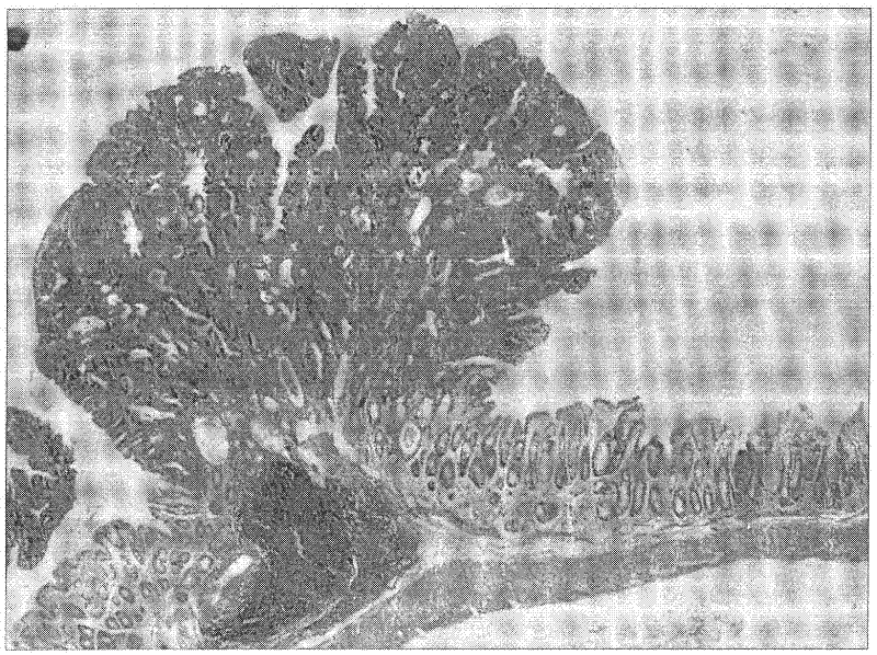 Pharmaceutical composition containing medicinal calcium salt for early preventing colorectal adenoma or colorectal cancer