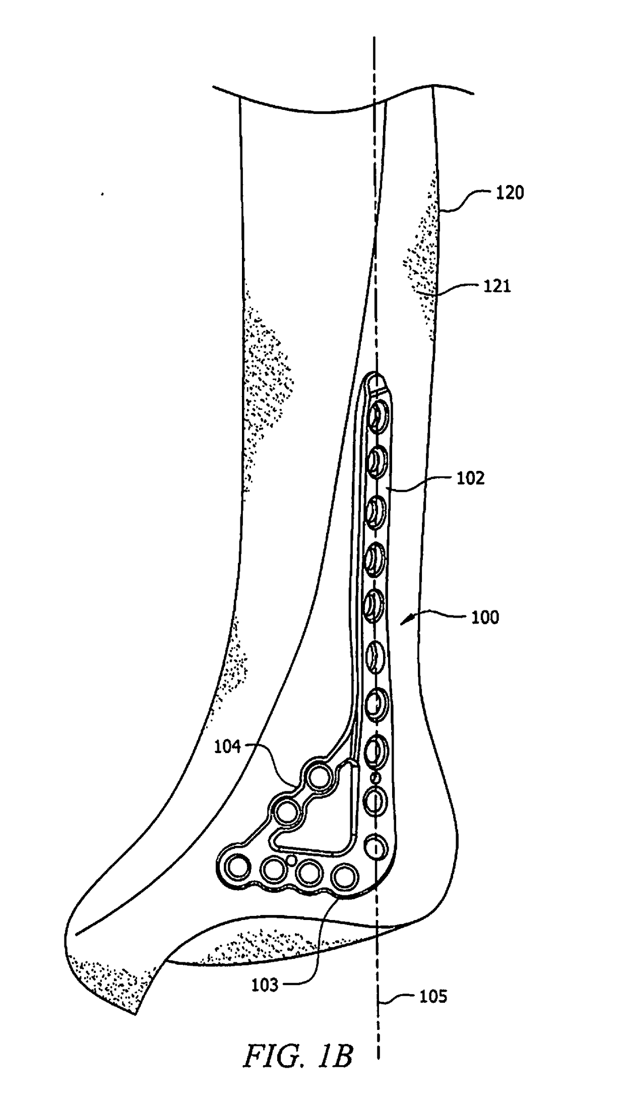 Ankle tibia plates