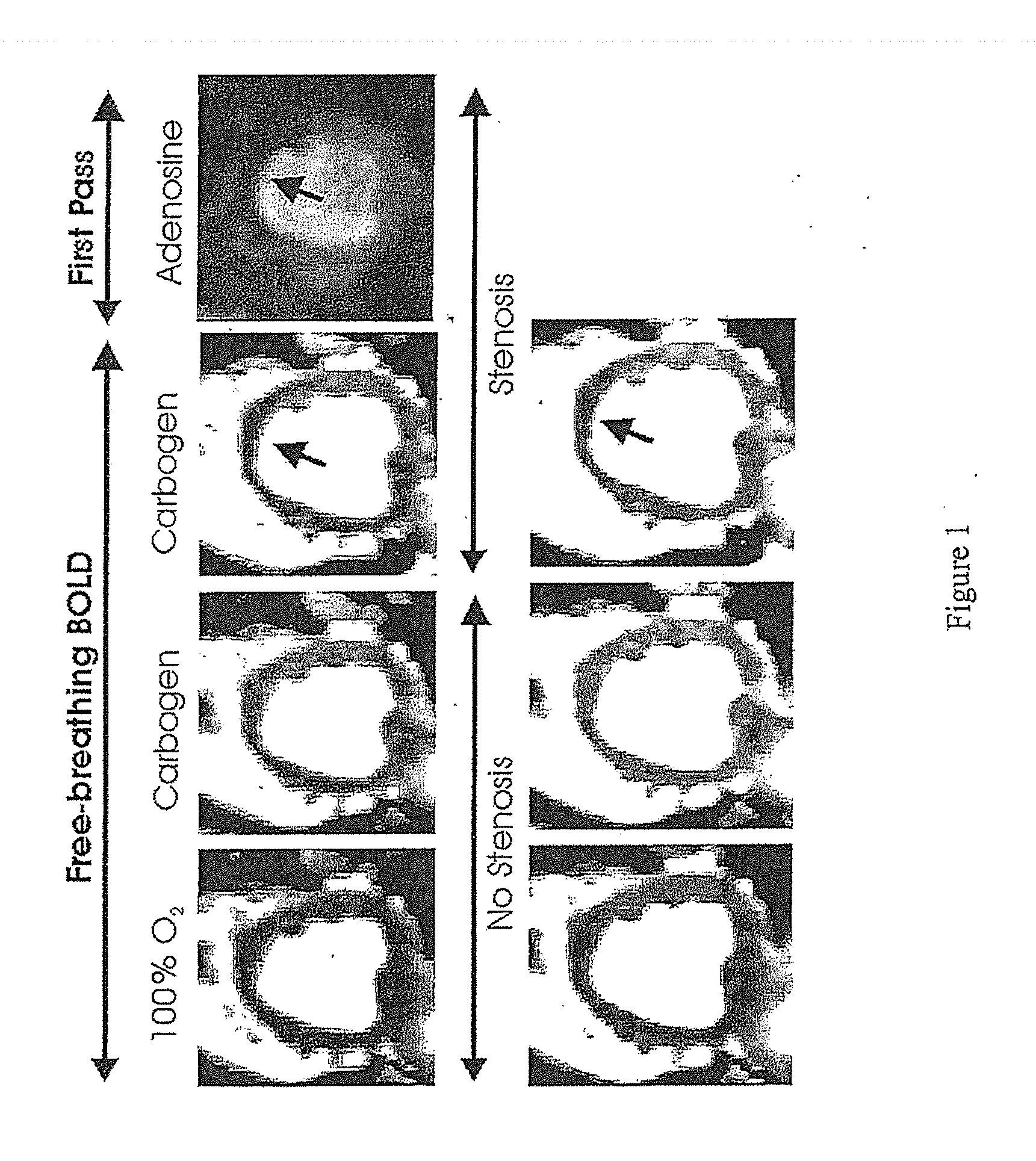 Assessment of coronary heart disease with carbon dioxide