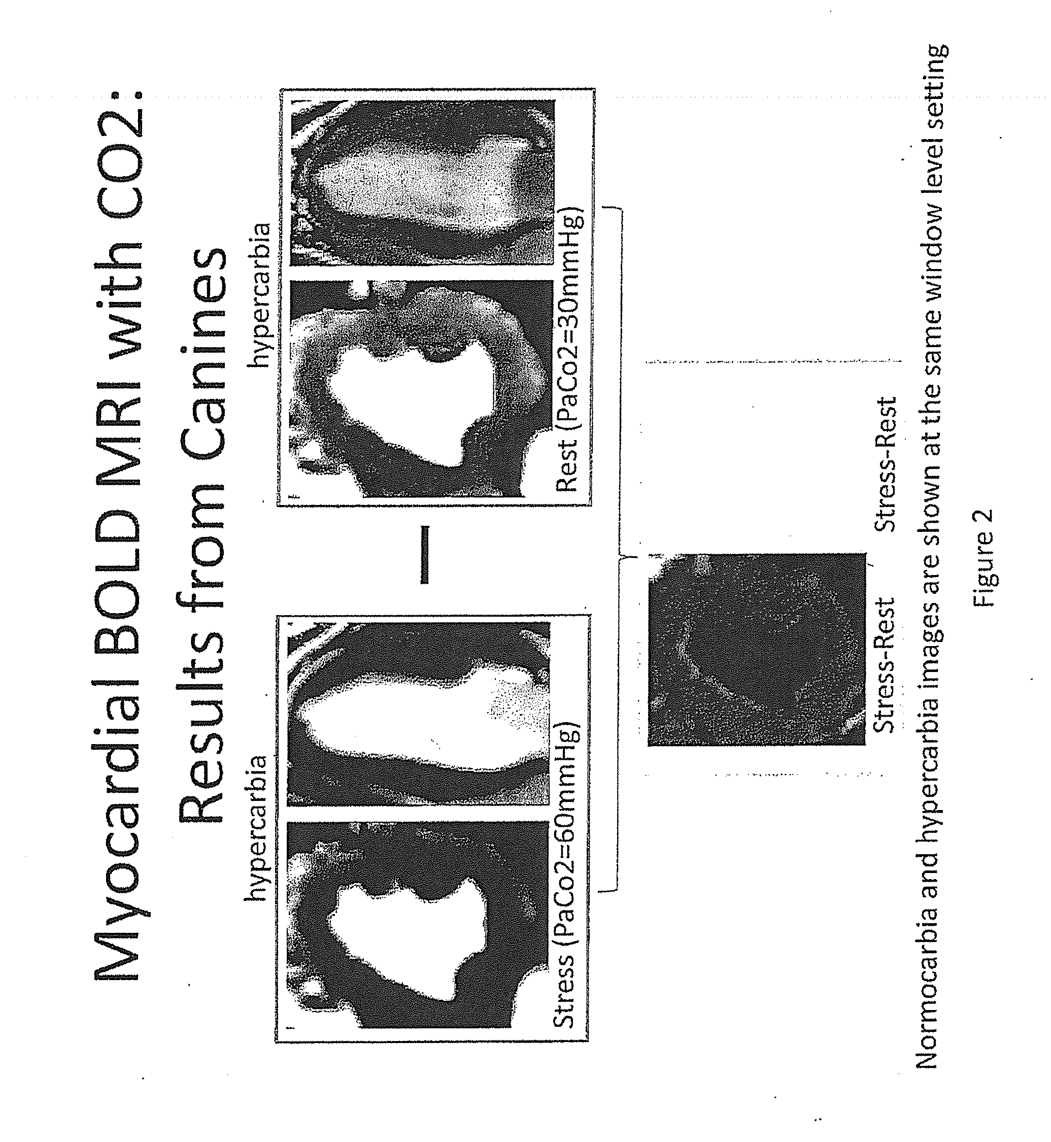 Assessment of coronary heart disease with carbon dioxide