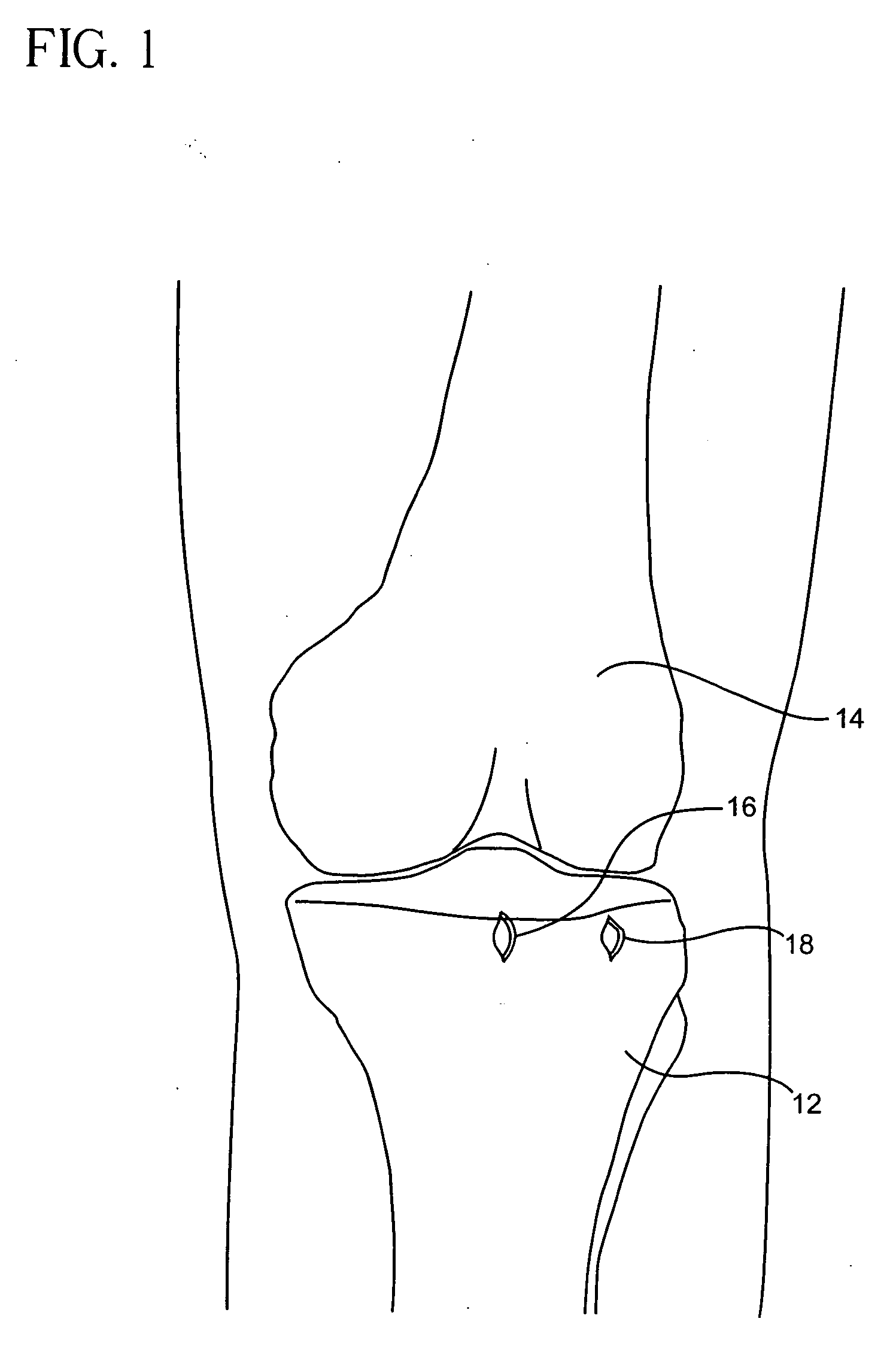 Method and apparatus for arthroscopic bone preparation