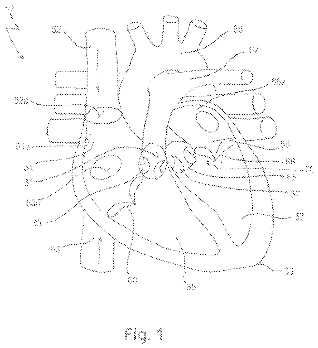 Prosthetic mitral valve coaptation enhancement device