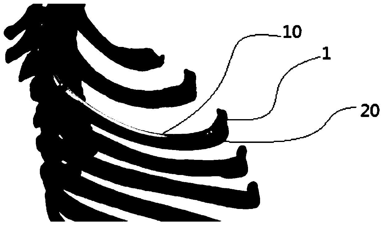 3D printing individual rib replacement prosthesis and preparation method thereof