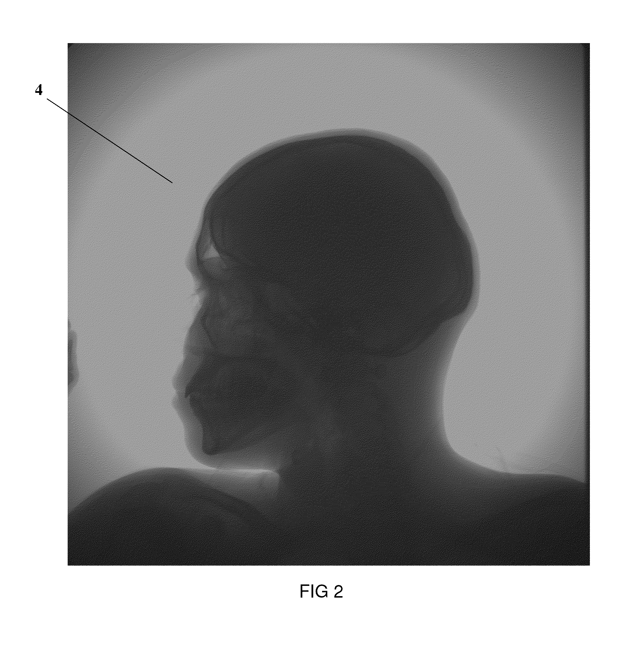 Method of noise reduction in digital x-rayograms