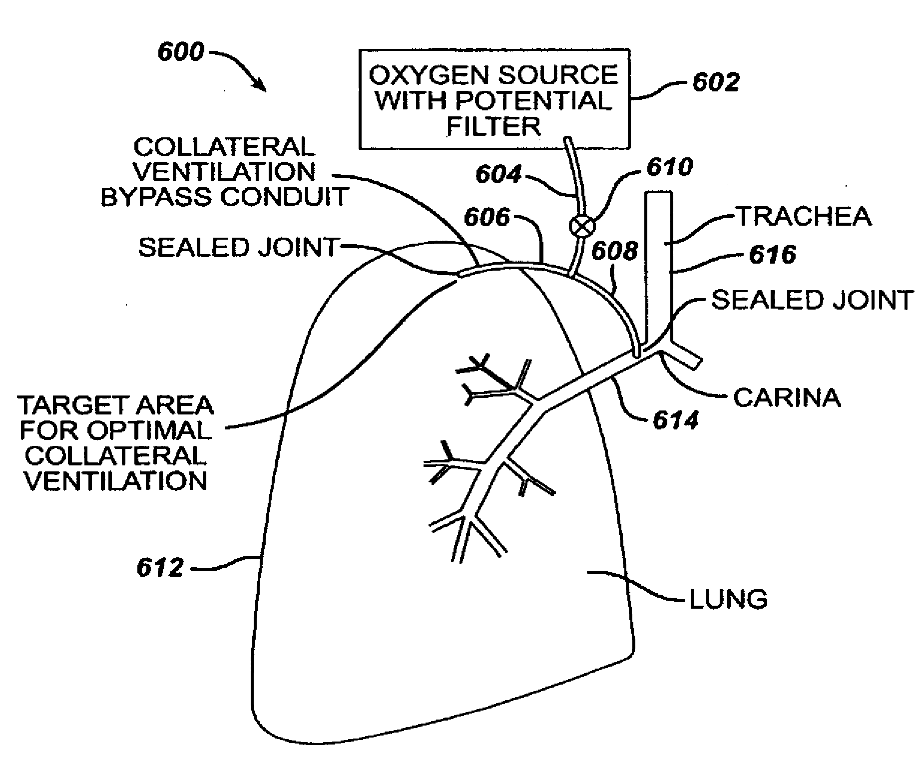 Lung reduction system