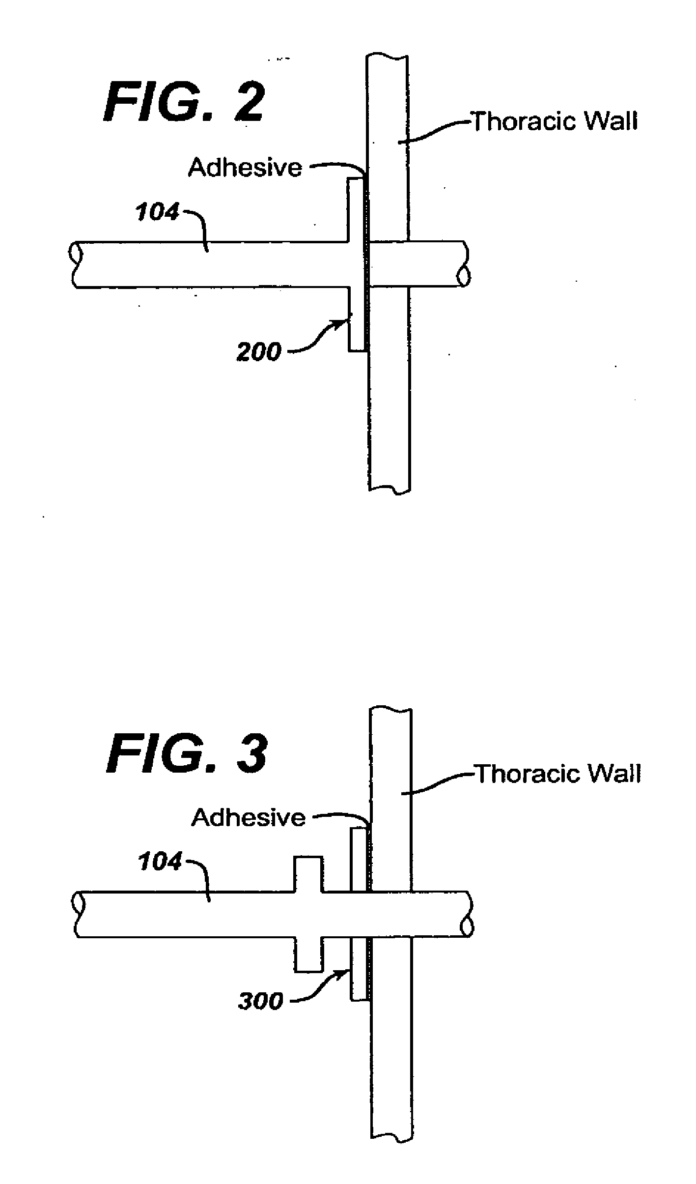 Lung reduction system