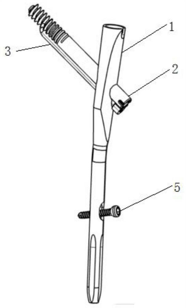 intramedullary implant system