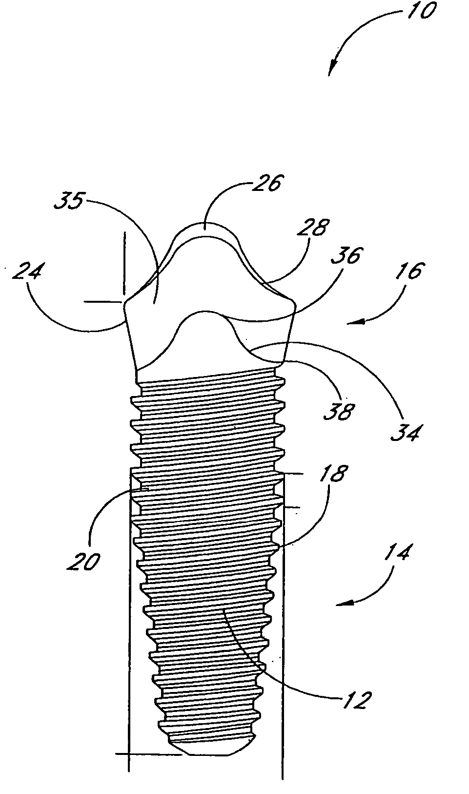 Dental implant system