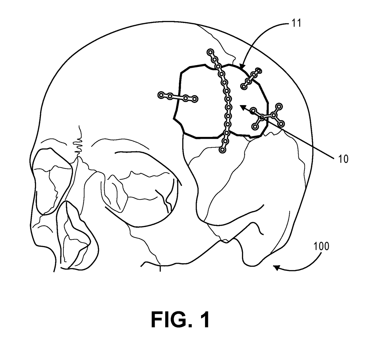 Low-profile intercranial device