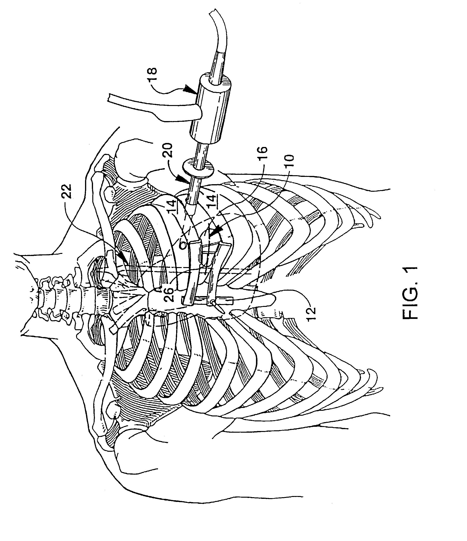 Method for coronary artery bypass