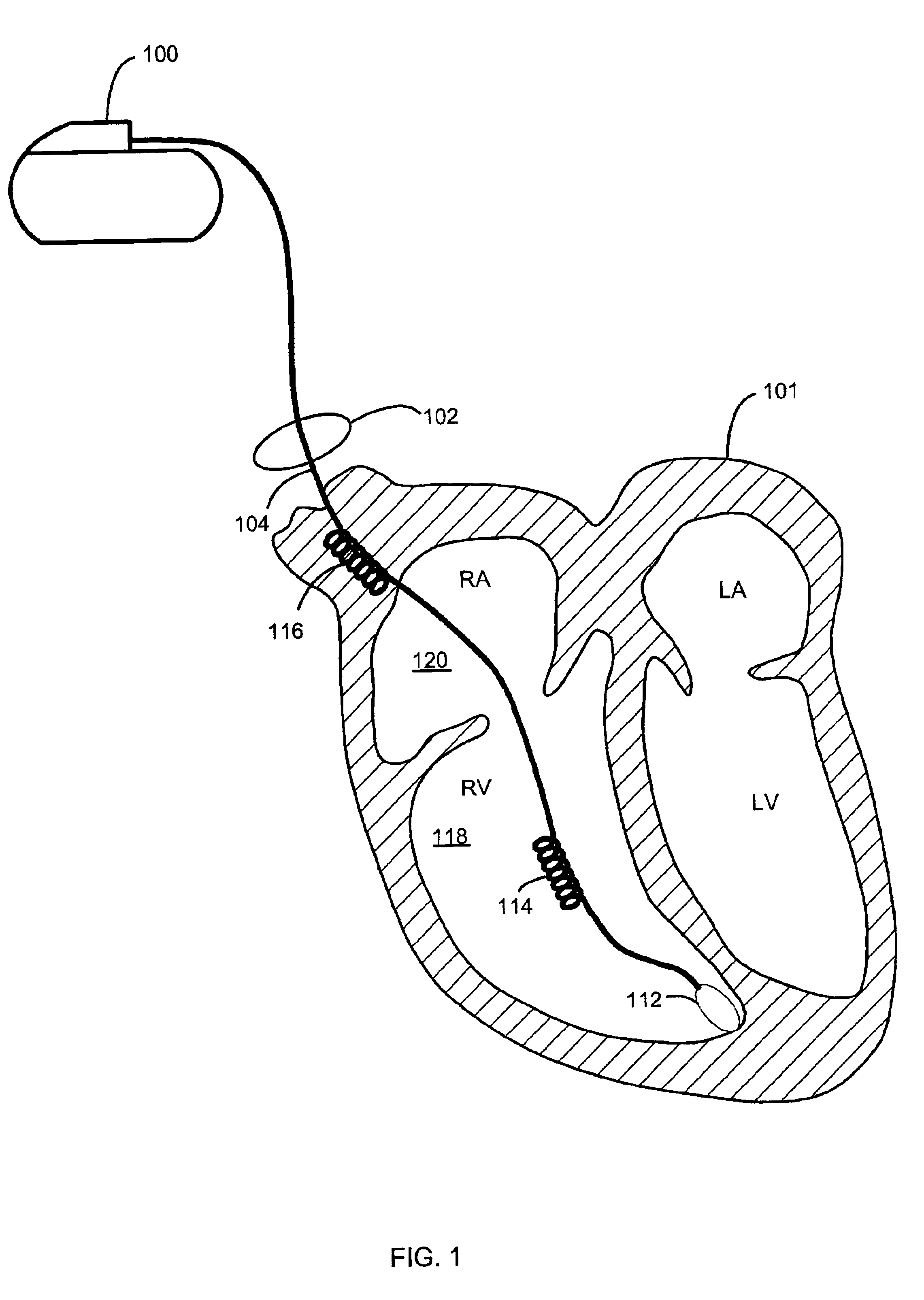 Method and system for characterizing supraventricular rhythm during cardiac pacing