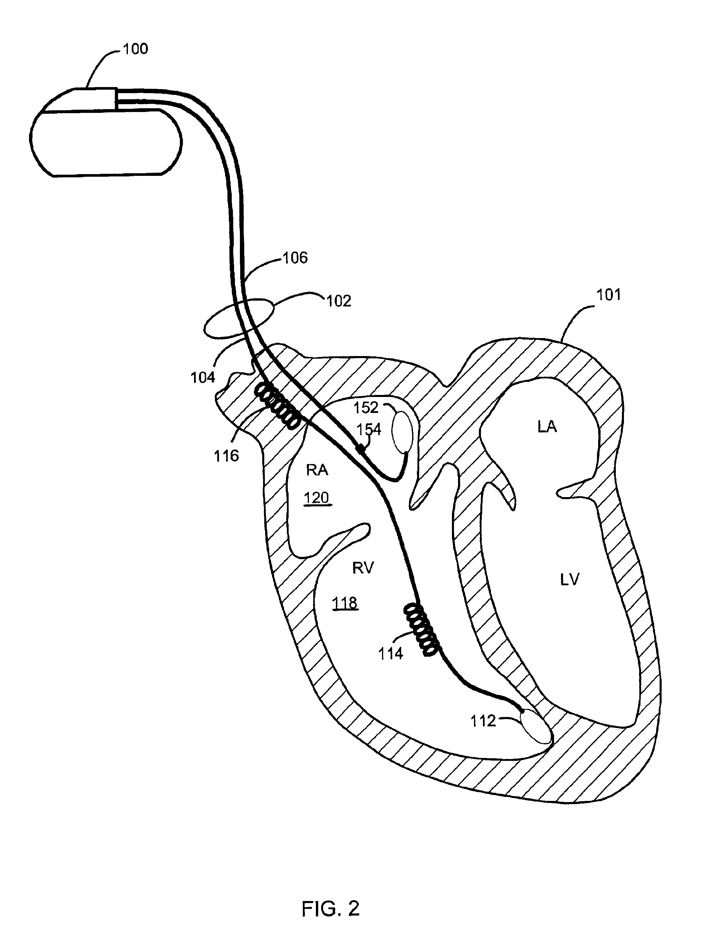 Method and system for characterizing supraventricular rhythm during cardiac pacing