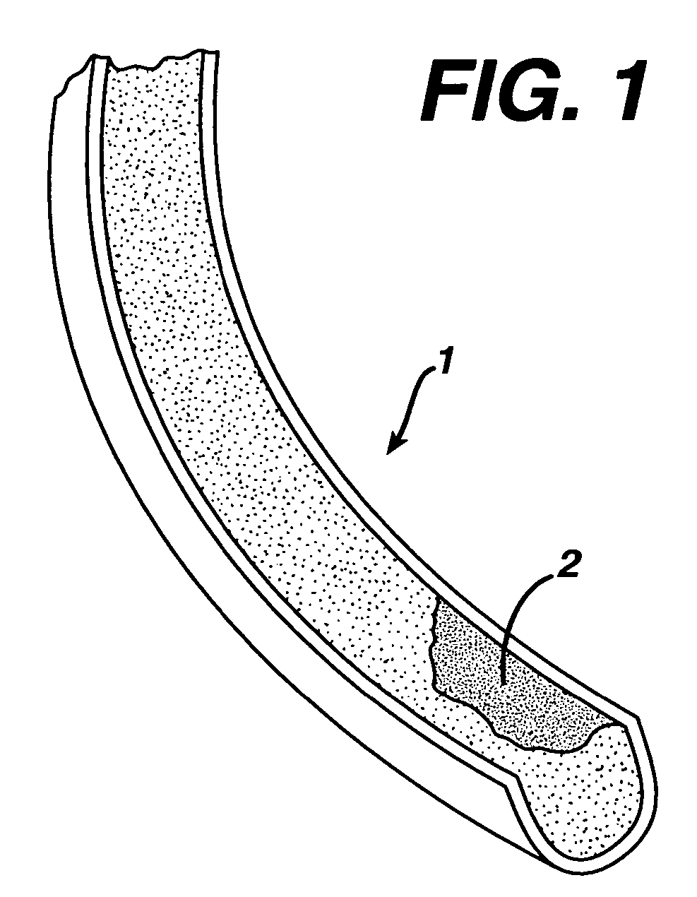 Systems and methods for treating a thrombus in a blood vessel