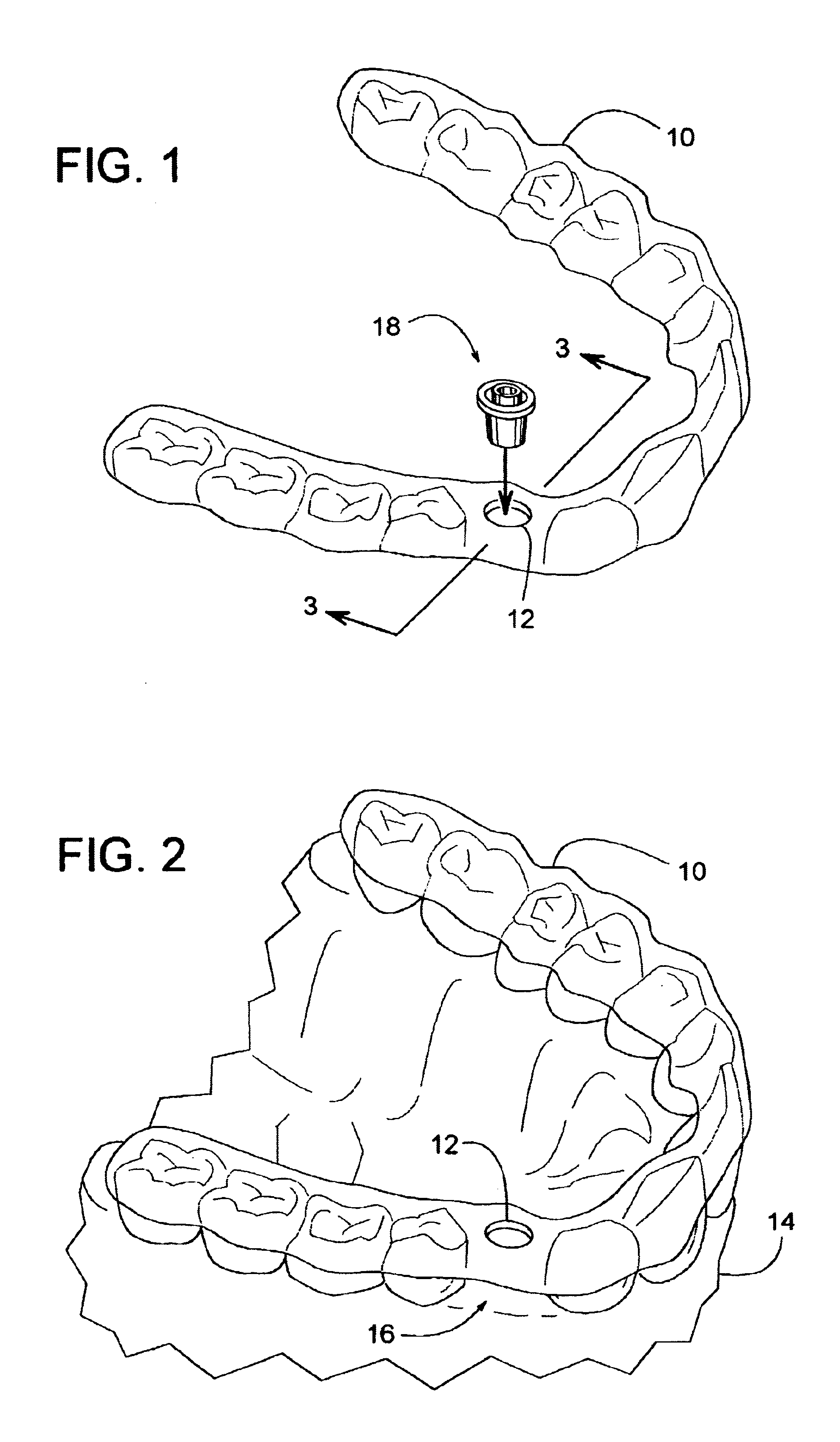 Dental implant tool with attachment feature