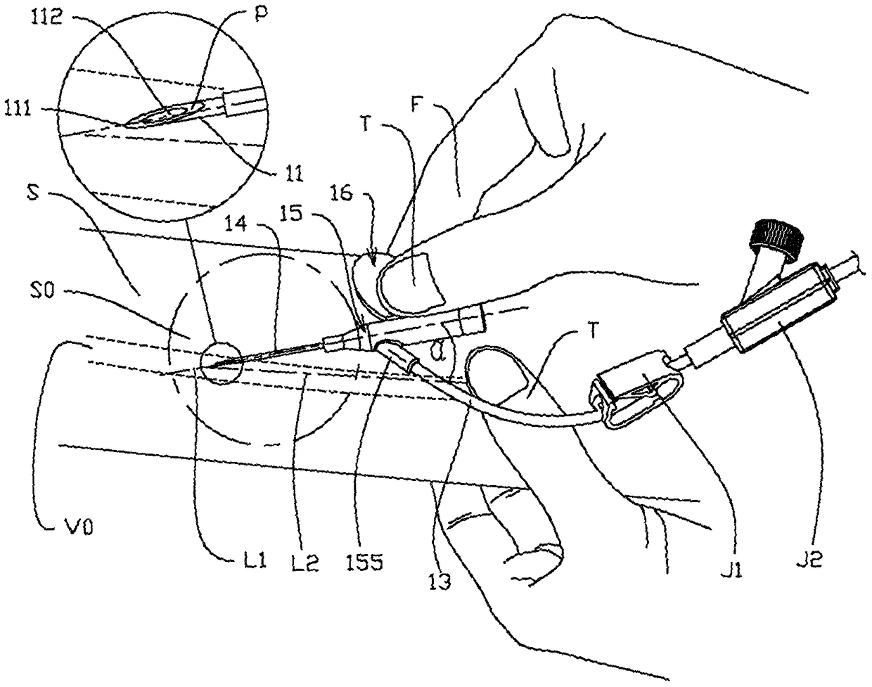 Safe-type venous indwelling needle