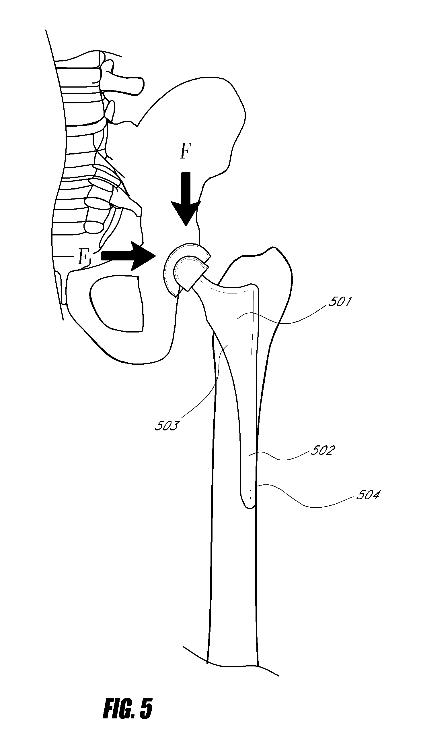 Stem for use in joint arthroplasty