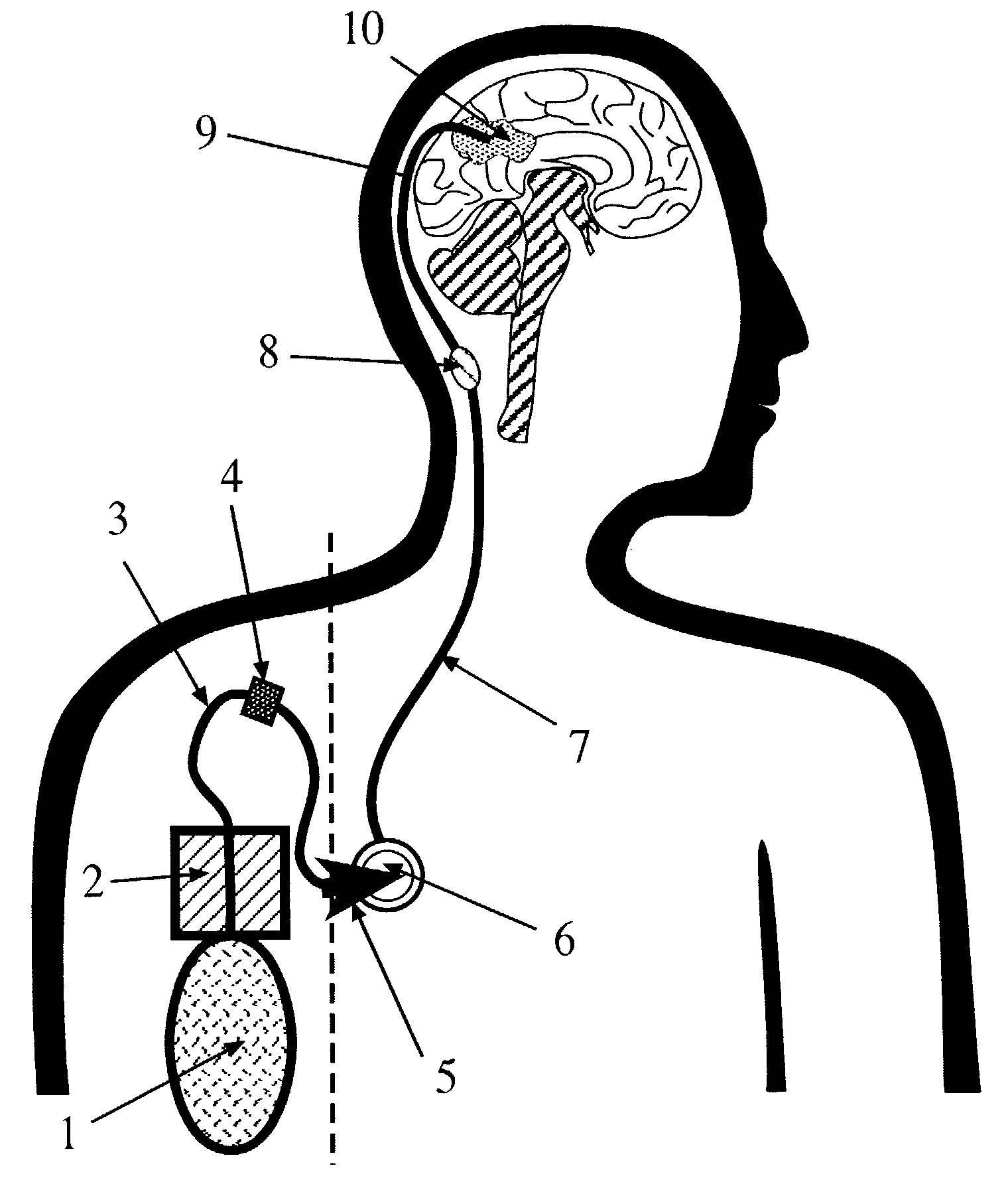 Portable equipment for administration of fluids into tissues and tumors by convection enhanced delivery technique