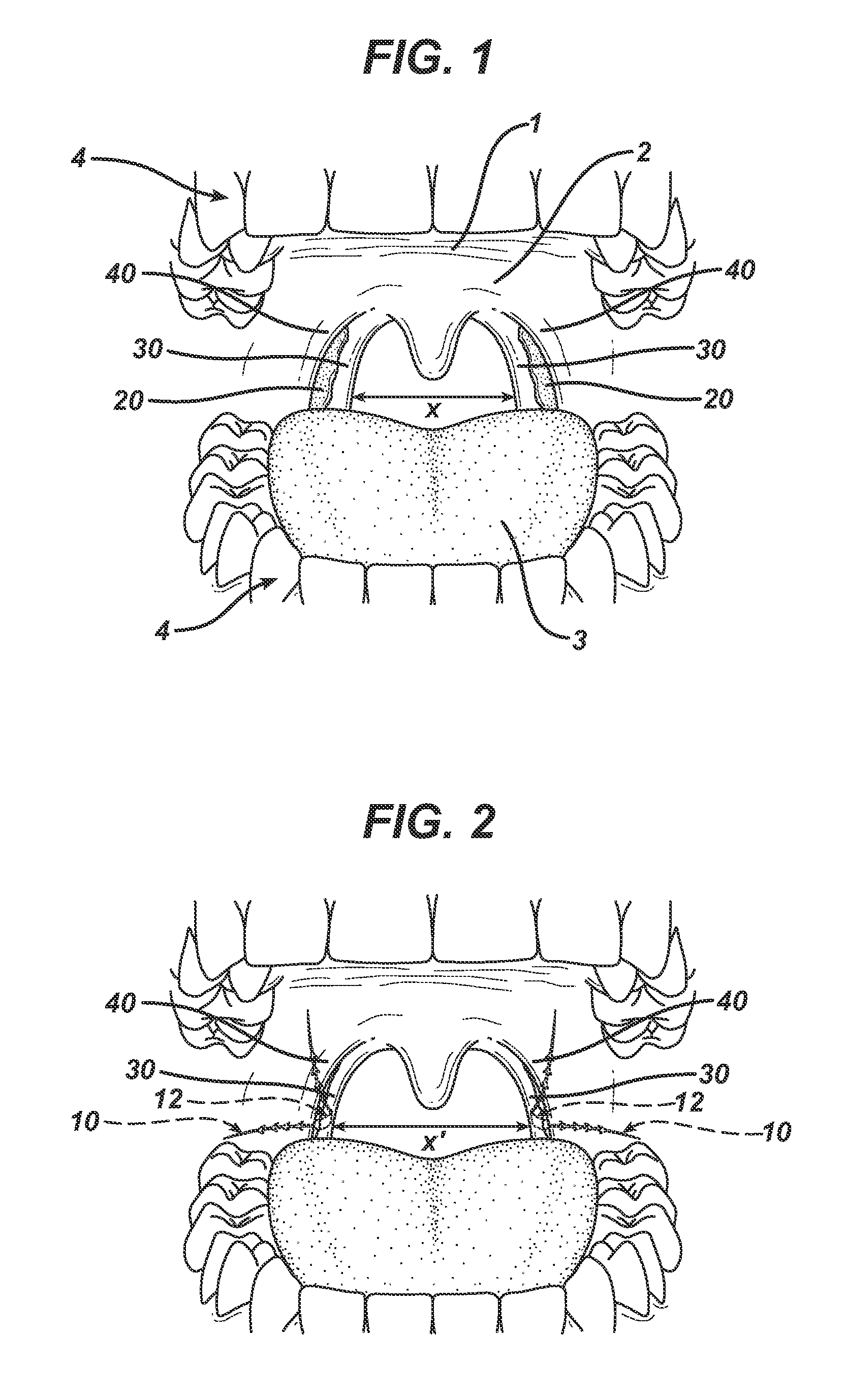 Systems and methods to treat upper pharyngeal airway of obstructive sleep apnea patients