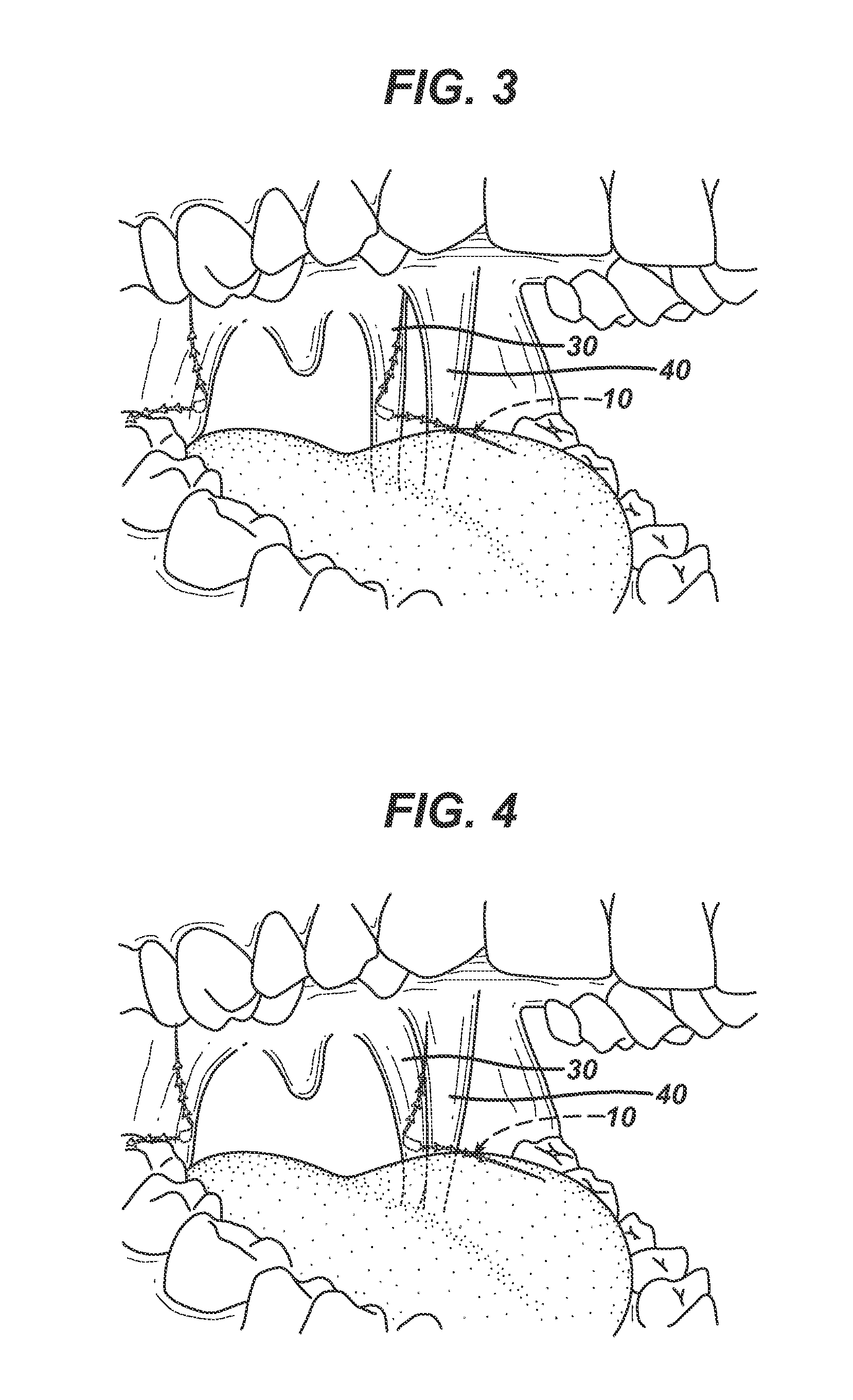 Systems and methods to treat upper pharyngeal airway of obstructive sleep apnea patients