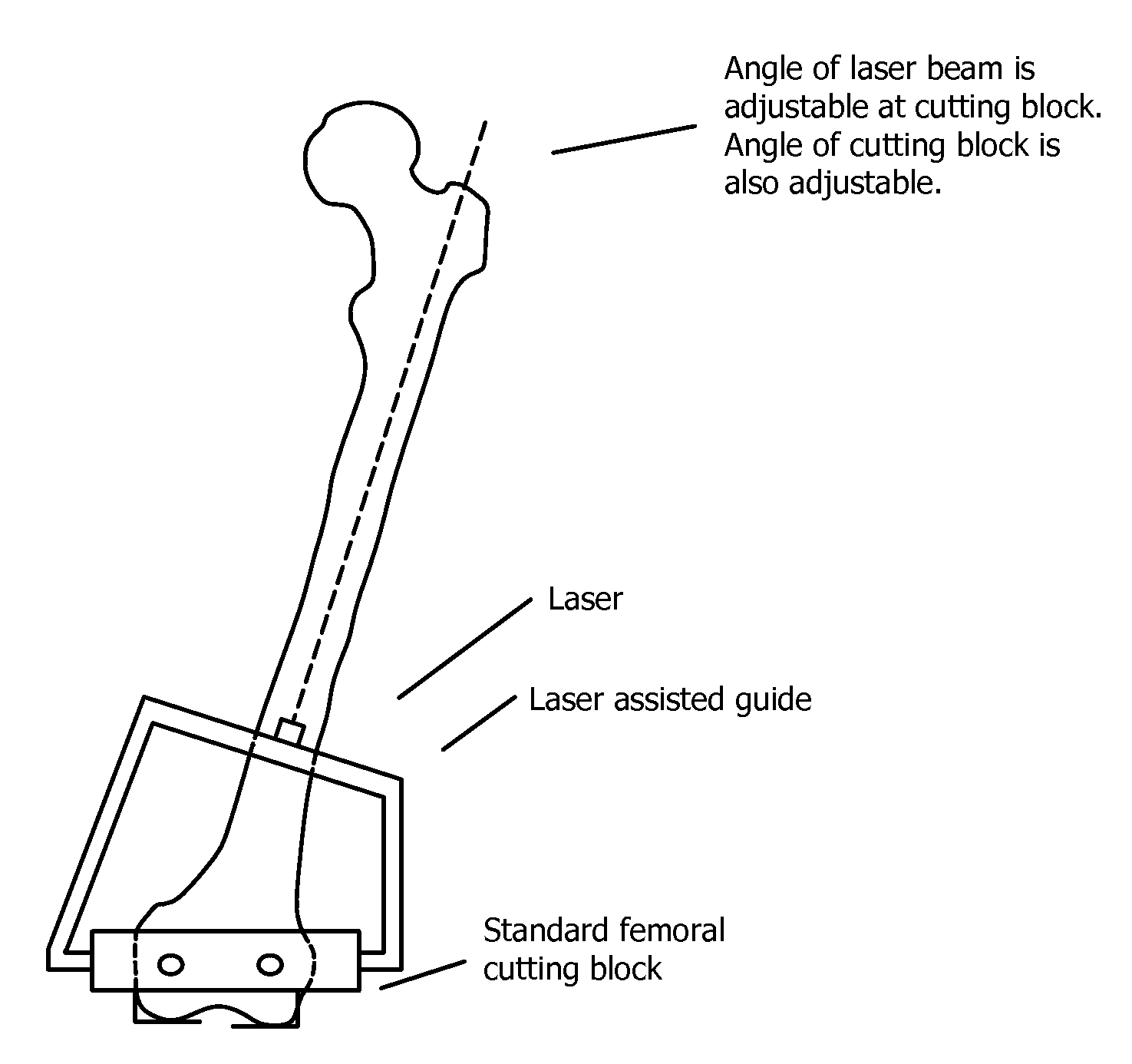 Laser assisted total joint arthroplasty