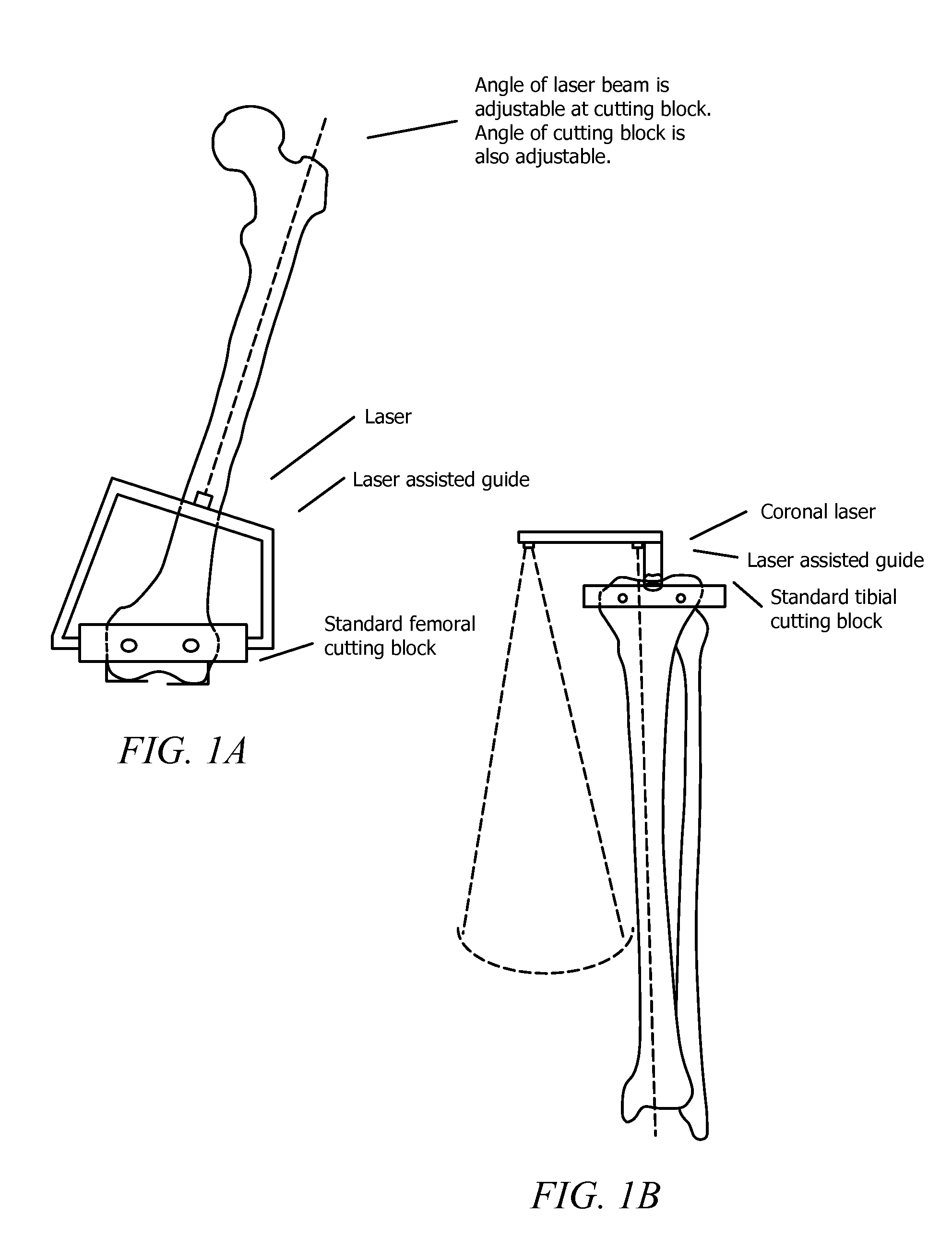 Laser assisted total joint arthroplasty