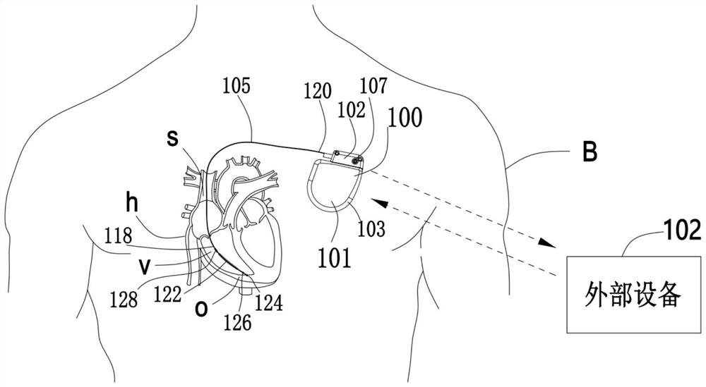 Implantable medical equipment for detecting T-wave over-perception by utilizing pressure sensor