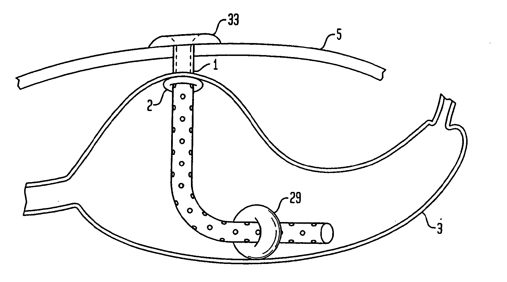 Method for treating obesity by extracting food