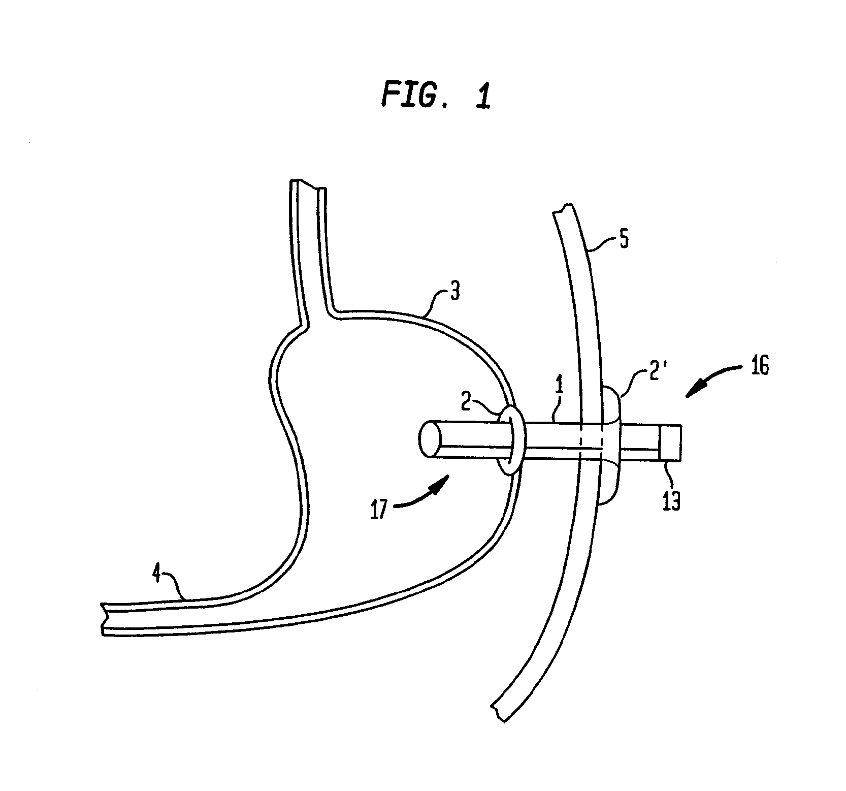 Method for treating obesity by extracting food