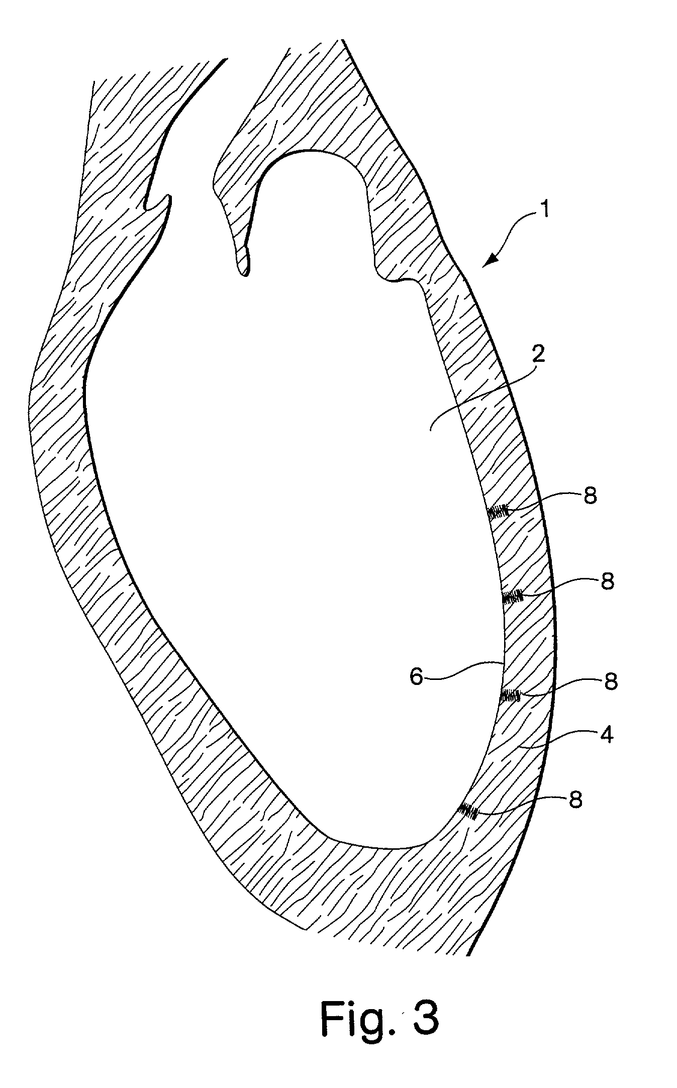 Vascular inducing implants