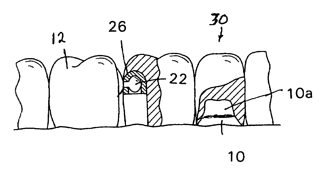 Dental connecting apparatus