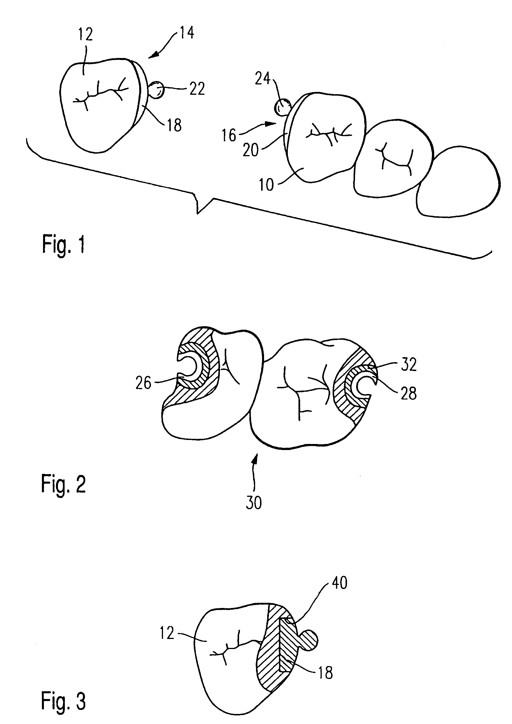 Dental connecting apparatus