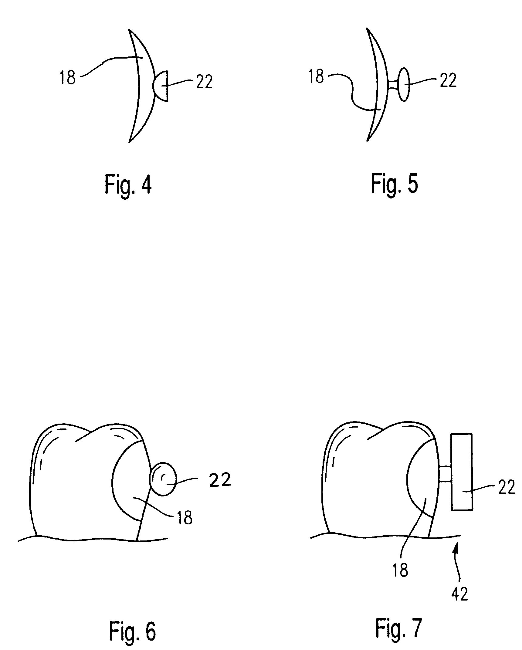 Dental connecting apparatus